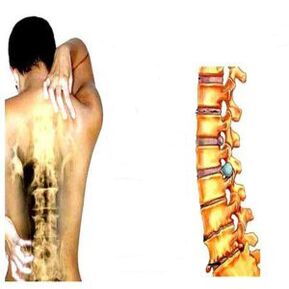 Estadios de osteocondrose