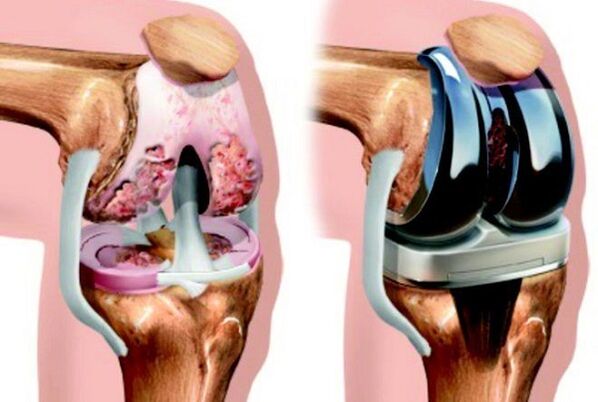 Antes e despois das endoprotéticas da articulación do xeonllo con artrose