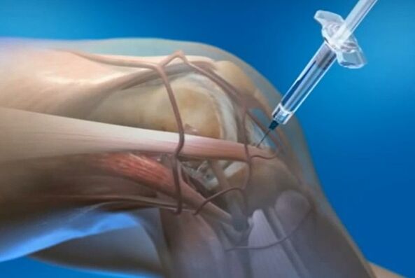 Inxeccións intra -karticulares para a artrose da articulación do xeonllo
