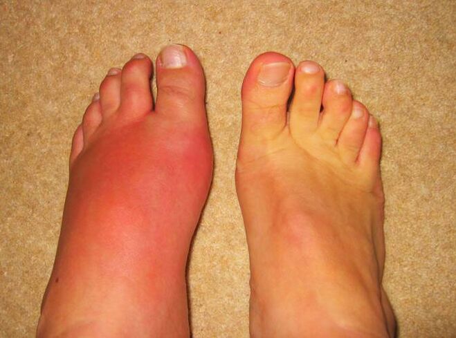 Dor nas articulacións das pernas debido á gota