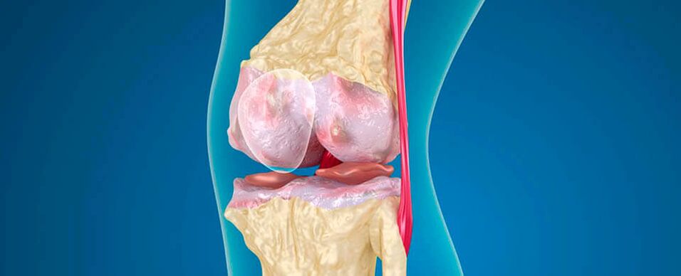 Osteoartrite da articulación do xeonllo