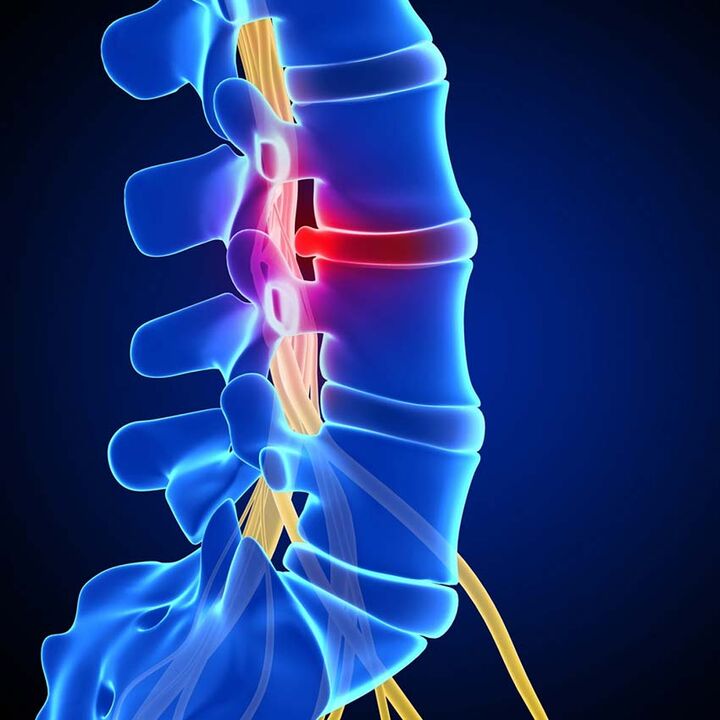 Abultamento do disco intervertebral na canle espinal como resultado da osteocondrose da columna lumbar