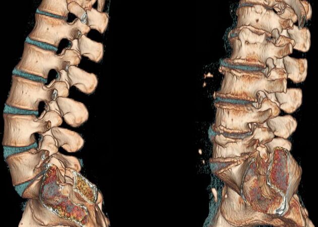 Osteocondrose da columna nunha tomografía computarizada